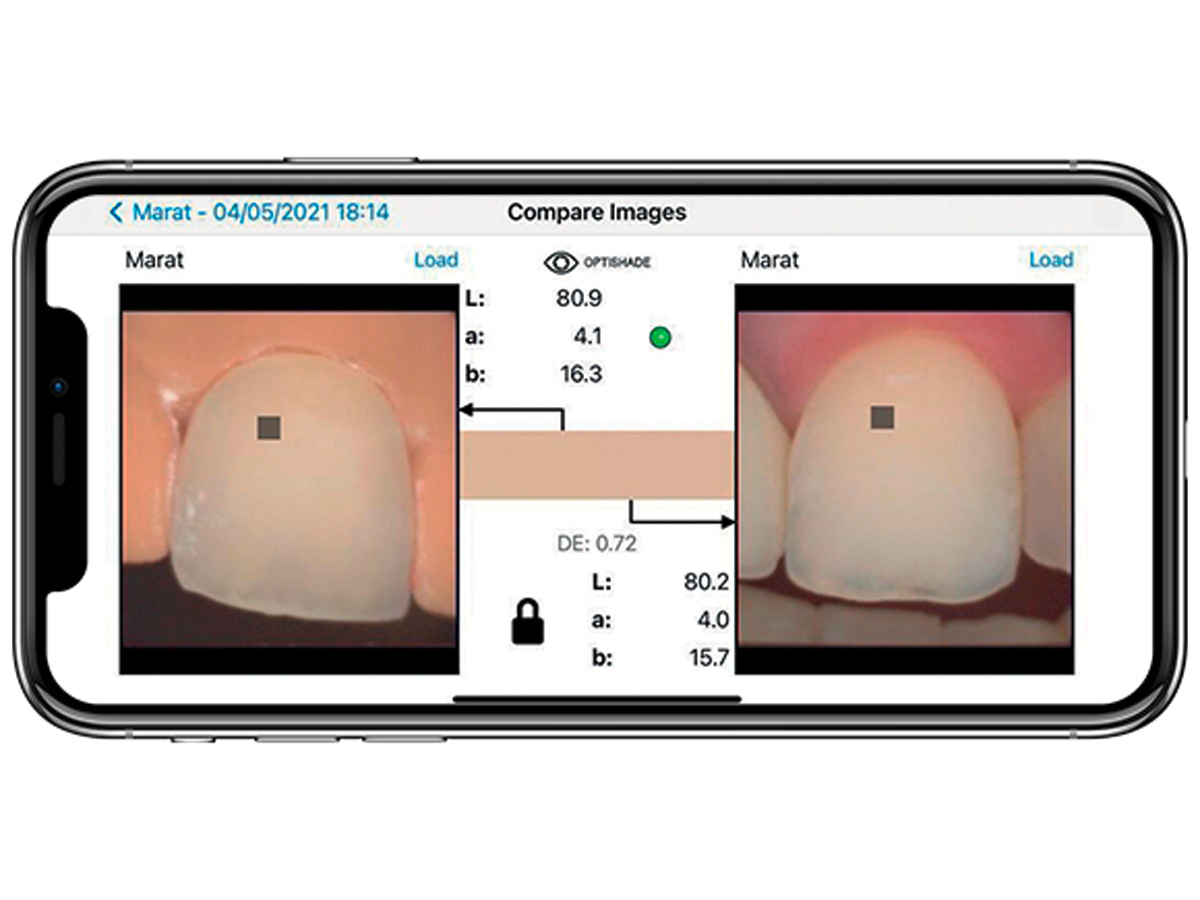 Smile Line Optishade Full Set Gold Quadrat Dental