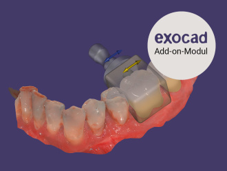 In-CAD-Nesting exocad Modul 1