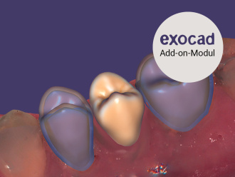 In-CAD-Nesting exocad Provisional Module Add-on