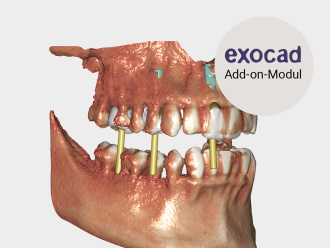 In-CAD-Nesting exocad DICOM Viewer-Add-on